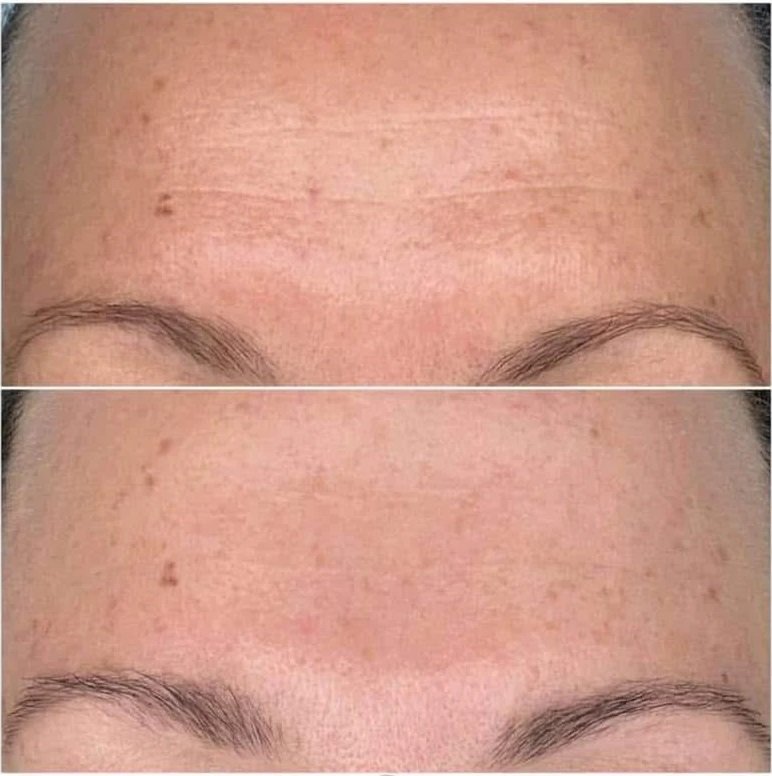 Shakee peptide wands review - 1 month before after - Stephanie - Shop Shaklee Australia Before and after results 1 month - Shaklee Peptide Wand